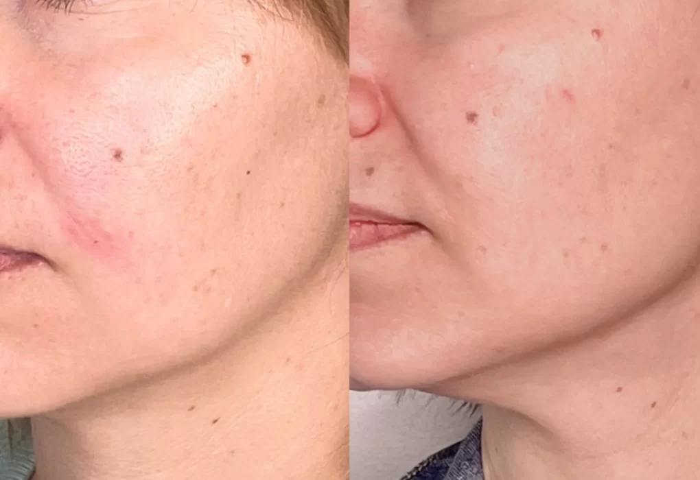 vitamin A retinoids skincare
