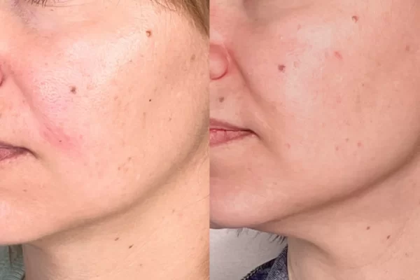 vitamin A retinoids skincare