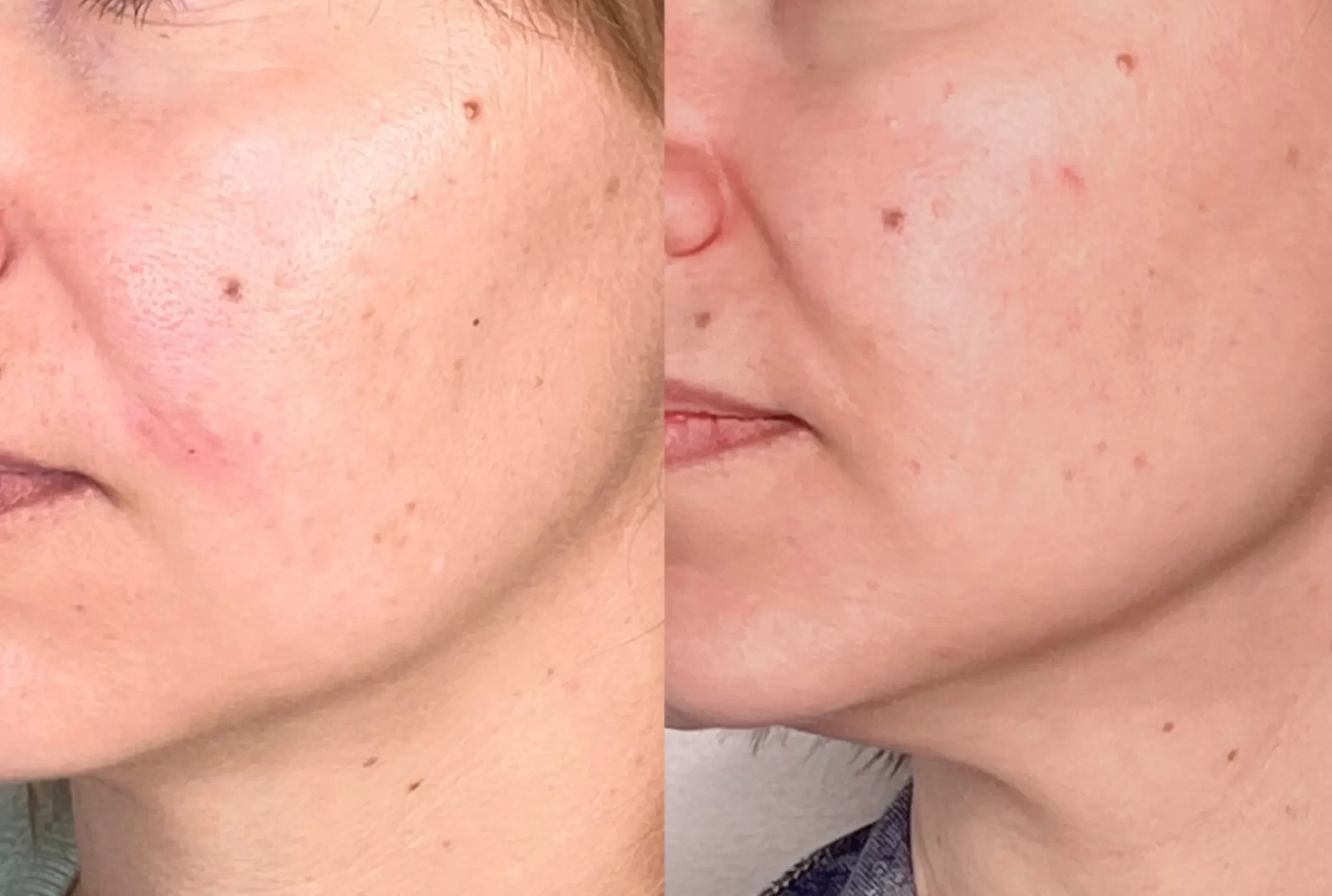 vitamin A retinoids skincare